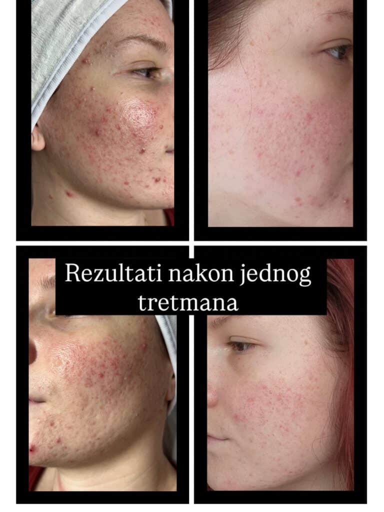 Tretman za rozacea akne pre i posle - prirodni rezultati bez antibiotika posle samo jednog tretmana