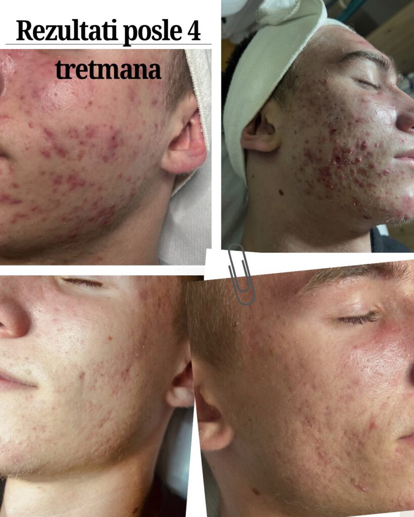 Rezultati tretmana za ožiljke i akne - pre i posle - Beograd Vozdovac