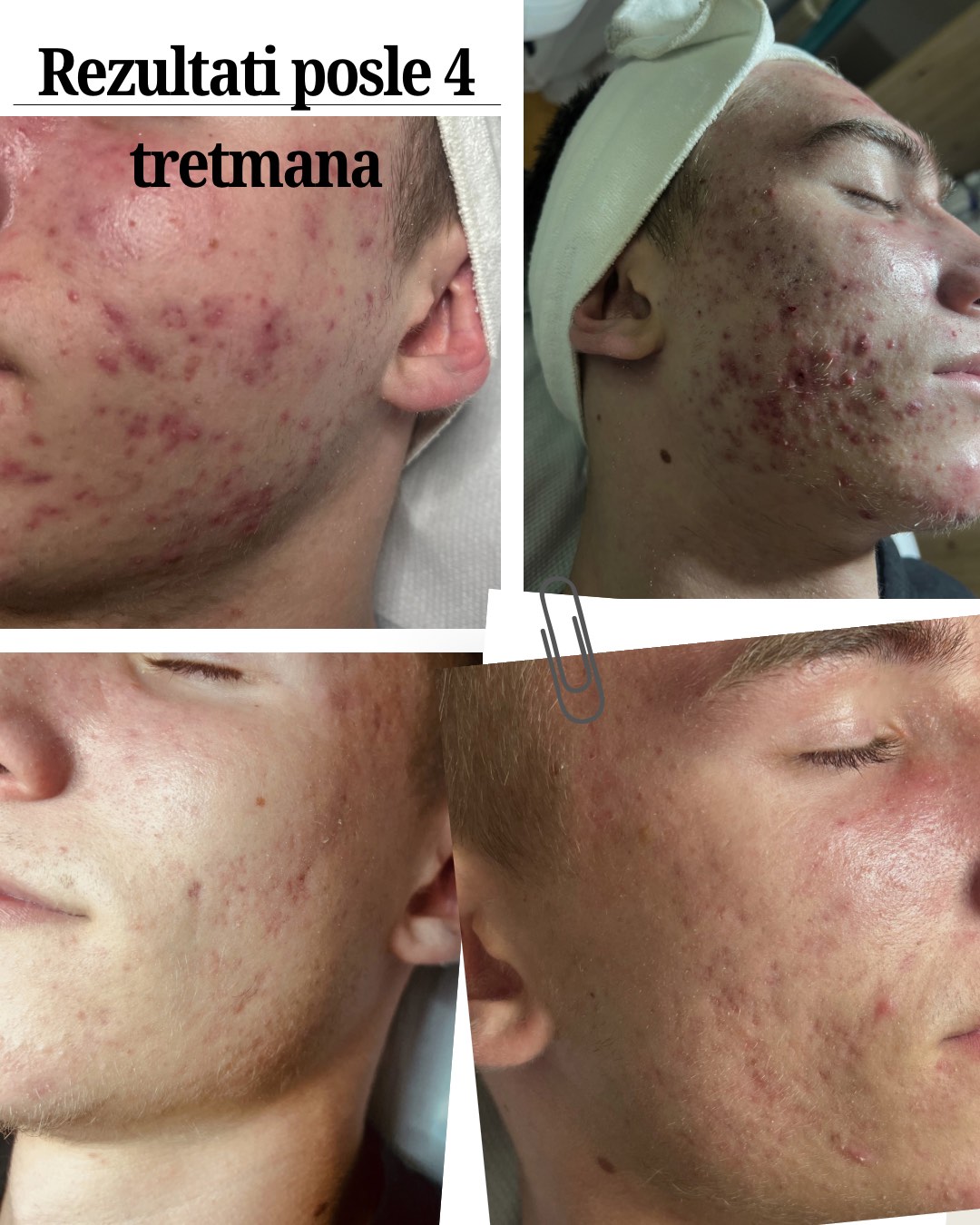 Holistički pristup aknama: Zašto kortikosteroidi i antibiotici ne pomažu (trajno rešenje za čistu kožu)